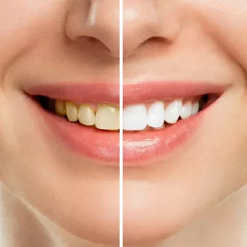 What Should You Avoid After Professional Teeth Whitening?